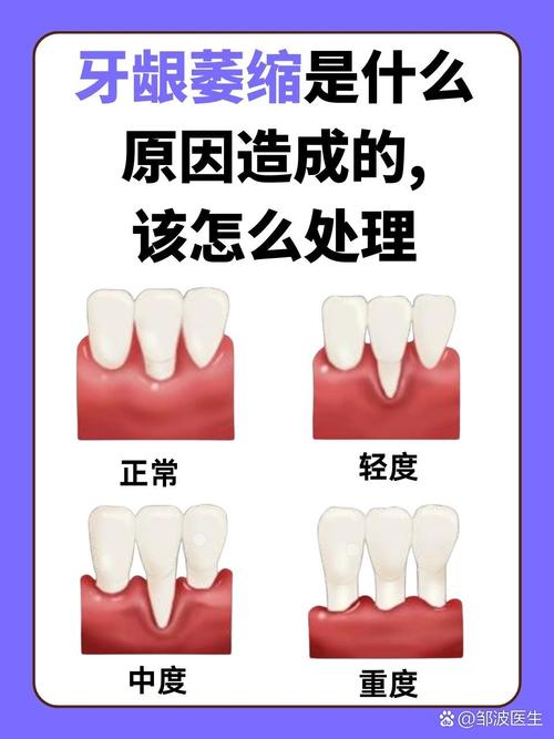 孕期牙龈增生会缩回去吗-第2张图片-中州医学会 孕期牙龈增生会缩回去吗-第2张图片-中州医学会