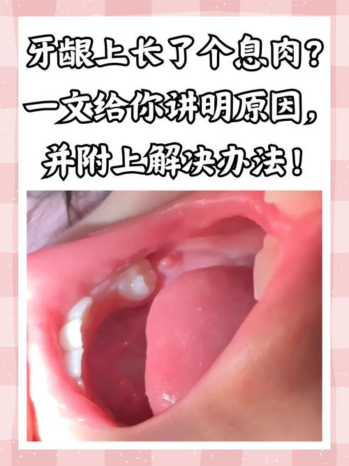 孕期牙龈增生会缩回去吗-第3张图片-中州医学会