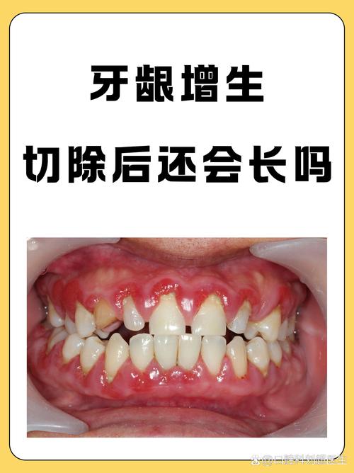 孕期牙龈增生会缩回去吗-第1张图片-中州医学会 孕期牙龈增生会缩回去吗-第1张图片-中州医学会