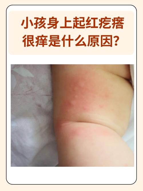 儿童全身瘙痒警惕哪些疾病？-第1张图片-中州医学会