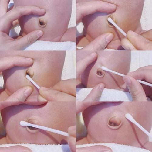 新生儿肚脐脱落后有分泌物怎么办？-第1张图片-郑州医学网