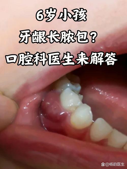 儿童牙龈长白色脓包是啥原因?-第1张图片-郑州医学网 儿童牙龈长白色脓包是啥原因?-第1张图片-郑州医学网