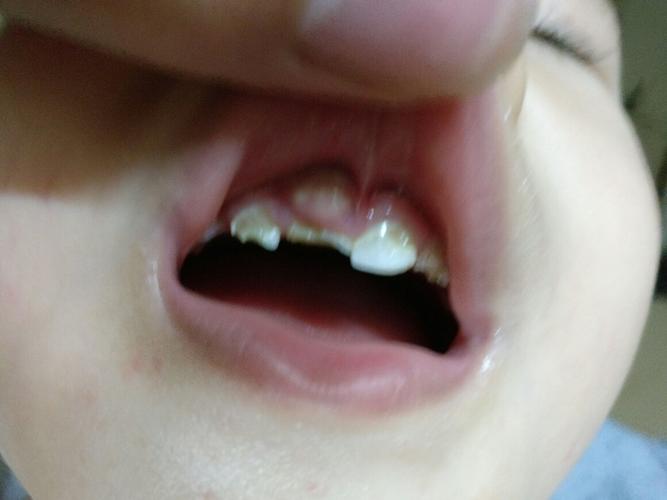 儿童牙龈长白色脓包是啥原因？-第3张图片-郑州医学网