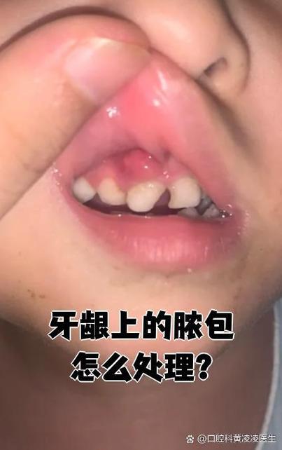 儿童牙龈长白色脓包是啥原因？-第2张图片-郑州医学网