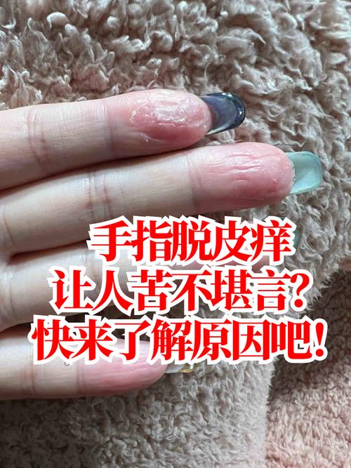 儿童手指脱皮是缺维生素还是皮肤病?-第2张图片-郑州医学网 儿童手指脱皮是缺维生素还是皮肤病?-第2张图片-郑州医学网
