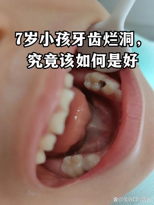 儿童大牙烂空了怎么办?-第2张图片-郑州医学网 儿童大牙烂空了怎么办?-第2张图片-郑州医学网