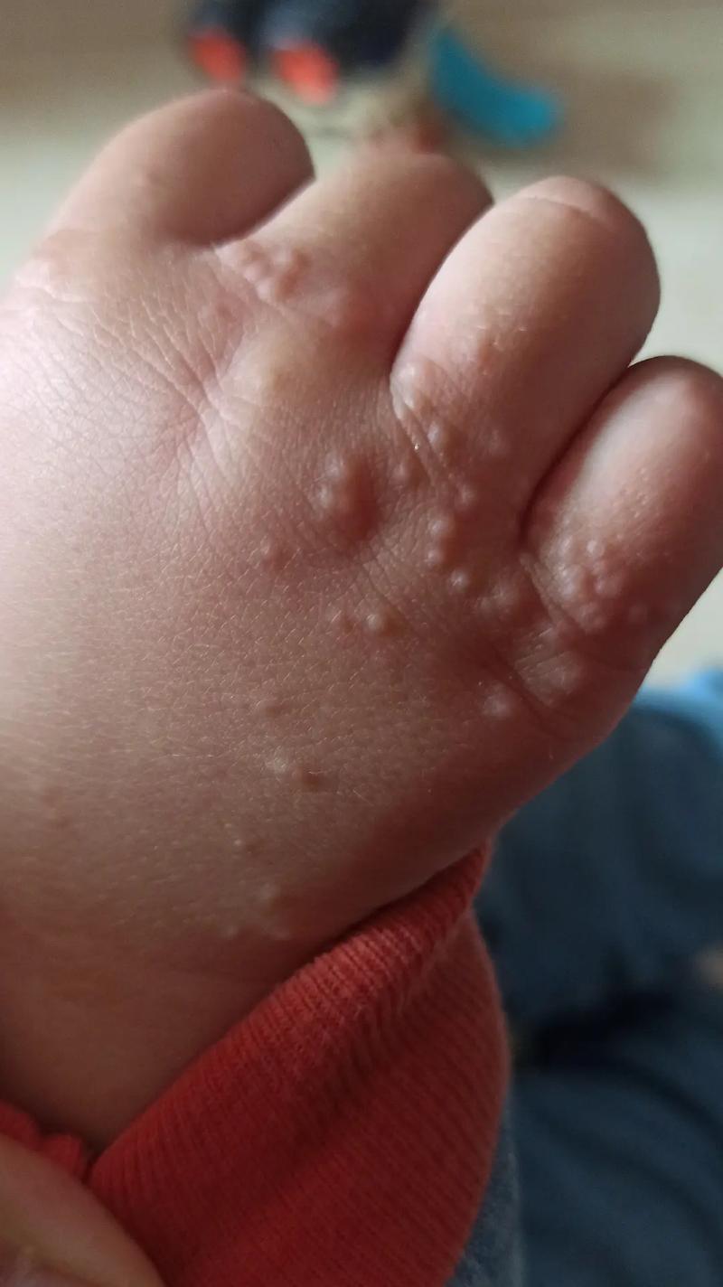 儿童手上小水泡怎么办？-第2张图片-郑州医学网