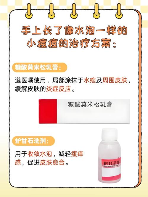 儿童手上小水泡怎么办?-第1张图片-郑州医学网 儿童手上小水泡怎么办?-第1张图片-郑州医学网