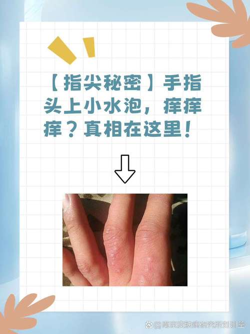 儿童手上小水泡怎么办?-第3张图片-郑州医学网 儿童手上小水泡怎么办?-第3张图片-郑州医学网