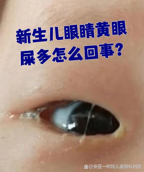 新生儿眼屎黄浓是上火还是生病？-第1张图片-郑州医学网