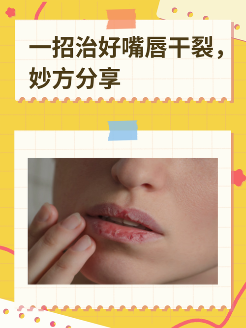 孕期嘴唇干裂怎么办？-第2张图片-郑州医学网