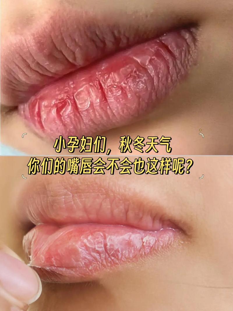 孕期嘴唇干裂怎么办?-第1张图片-郑州医学网 孕期嘴唇干裂怎么办?-第1张图片-郑州医学网