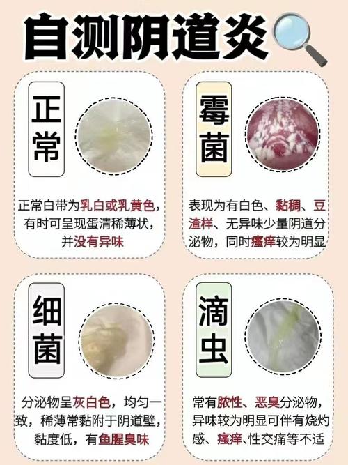 孕期水样白带是怎么回事-第2张图片-郑州医学网