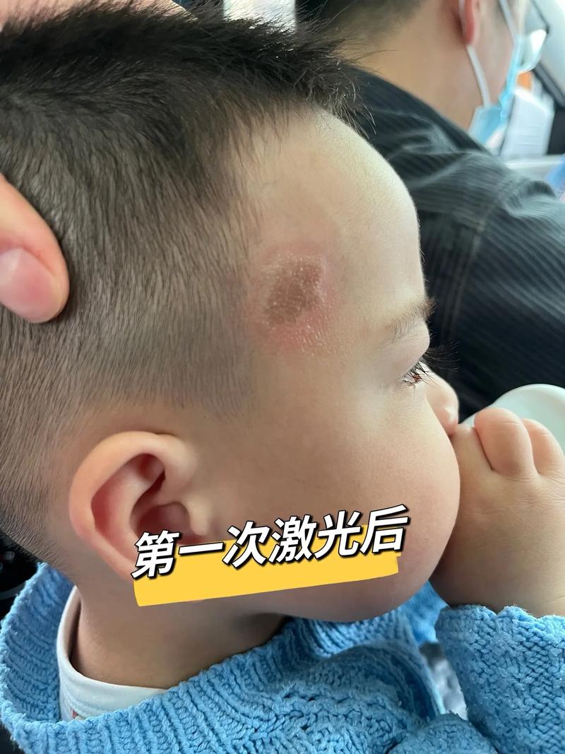 儿童咖啡斑如何成功治愈？-第2张图片-郑州医学网