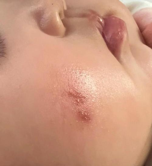 儿童咖啡斑如何成功治愈？-第1张图片-郑州医学网