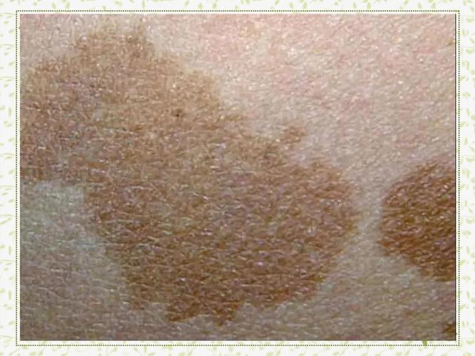 儿童咖啡斑如何成功治愈？-第3张图片-郑州医学网