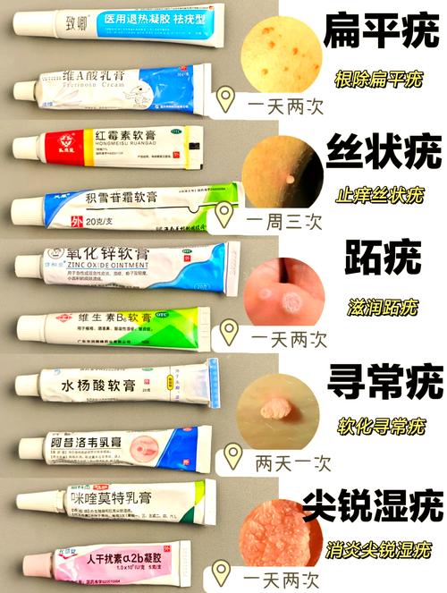 孕期长扁平疣怎么治？-第2张图片-郑州医学网