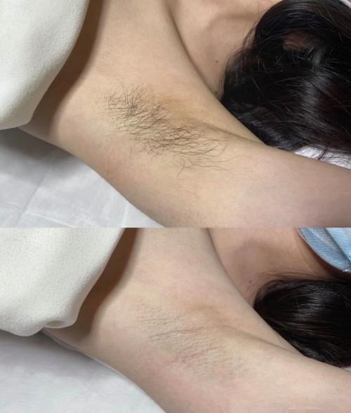 备孕期脱腋毛安全吗？-第1张图片-郑州医学网