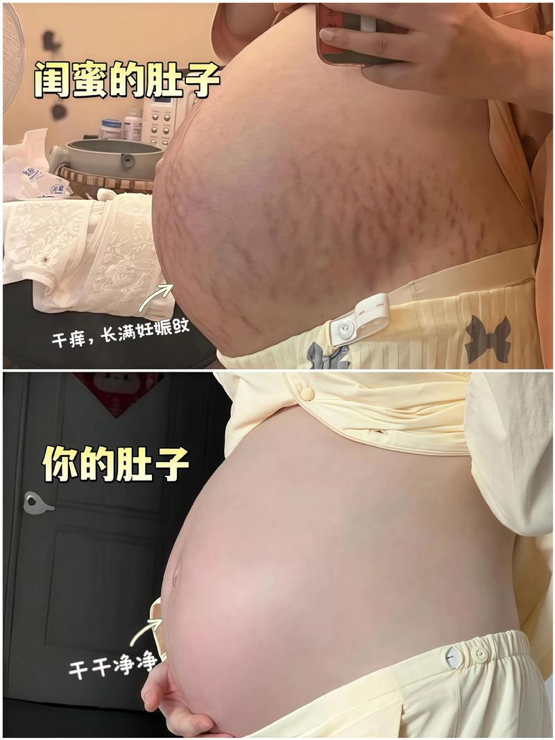 孕期吃什么能防妊娠纹？-第1张图片-郑州医学网