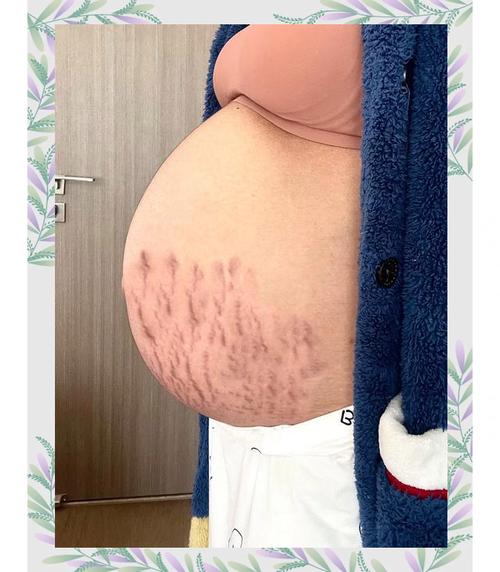 孕期吃什么能防妊娠纹？-第2张图片-郑州医学网