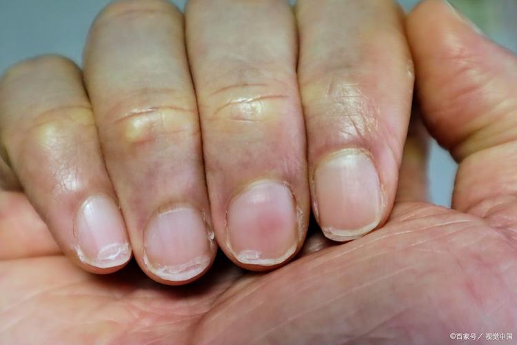孕期指甲莫名变黄，是身体发出的健康警报吗？-第2张图片-郑州医学网