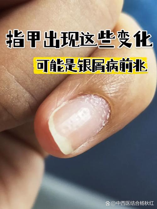 孕期指甲莫名变黄，是身体发出的健康警报吗？-第3张图片-郑州医学网