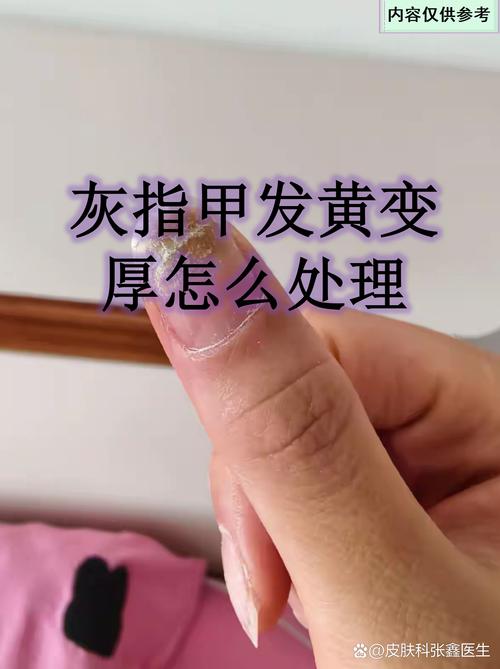 孕期指甲莫名变黄，是身体发出的健康警报吗？-第1张图片-郑州医学网