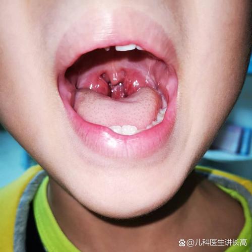 喉软骨发育不全的新生儿该如何科学护理与干预？-第2张图片-郑州医学网