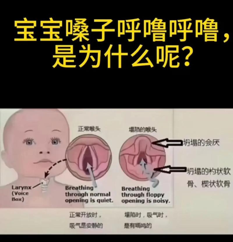 喉软骨发育不全的新生儿该如何科学护理与干预?-第3张图片-郑州医学网 喉软骨发育不全的新生儿该如何科学护理与干预?-第3张图片-郑州医学网