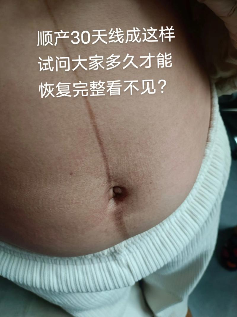 孕期什么时候长妊娠线-第2张图片-郑州医学网 孕期什么时候长妊娠线-第2张图片-郑州医学网