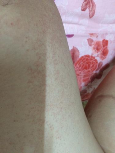 怀孕期间大腿内侧变黑是激素变化还是营养不良?-第3张图片-郑州医学网 怀孕期间大腿内侧变黑是激素变化还是营养不良?-第3张图片-郑州医学网