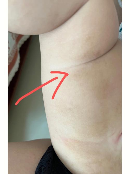 怀孕期间大腿内侧变黑是激素变化还是营养不良?-第1张图片-郑州医学网 怀孕期间大腿内侧变黑是激素变化还是营养不良?-第1张图片-郑州医学网