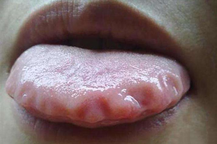 孕期舌头边缘锯齿状是缺锌还是脾虚？孕期舌头边缘锯齿状需要警惕哪些健康问题？-第1张图片-郑州医学网