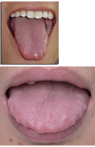 孕期舌头边缘锯齿状是缺锌还是脾虚？孕期舌头边缘锯齿状需要警惕哪些健康问题？-第3张图片-郑州医学网