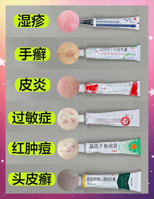 儿童湿疹药膏怎么选?不同类型湿疹该用哪种药膏最安全有效?-第1张图片-郑州医学网 儿童湿疹药膏怎么选?不同类型湿疹该用哪种药膏最安全有效?-第1张图片-郑州医学网