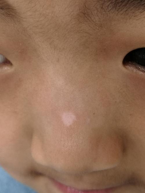 儿童白癜风早期症状图片有哪些典型表现?如何通过图片识别初期白斑?-第3张图片-郑州医学网 儿童白癜风早期症状图片有哪些典型表现?如何通过图片识别初期白斑?-第3张图片-郑州医学网