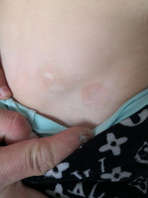 儿童白癜风早期症状图片有哪些典型表现?如何通过图片识别初期白斑?-第2张图片-郑州医学网 儿童白癜风早期症状图片有哪些典型表现?如何通过图片识别初期白斑?-第2张图片-郑州医学网