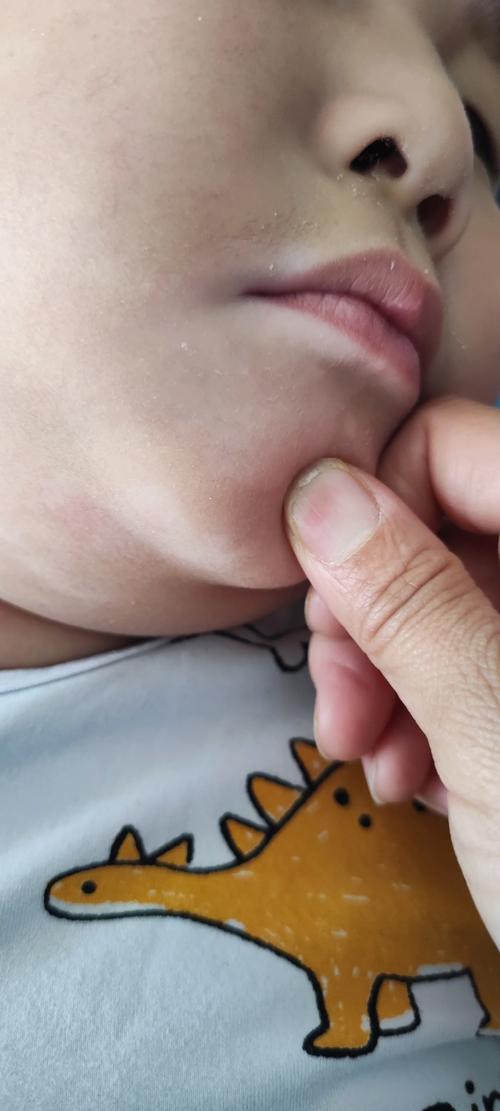 儿童白癜风早期症状图片有哪些典型表现?如何通过图片识别初期白斑?-第1张图片-郑州医学网 儿童白癜风早期症状图片有哪些典型表现?如何通过图片识别初期白斑?-第1张图片-郑州医学网