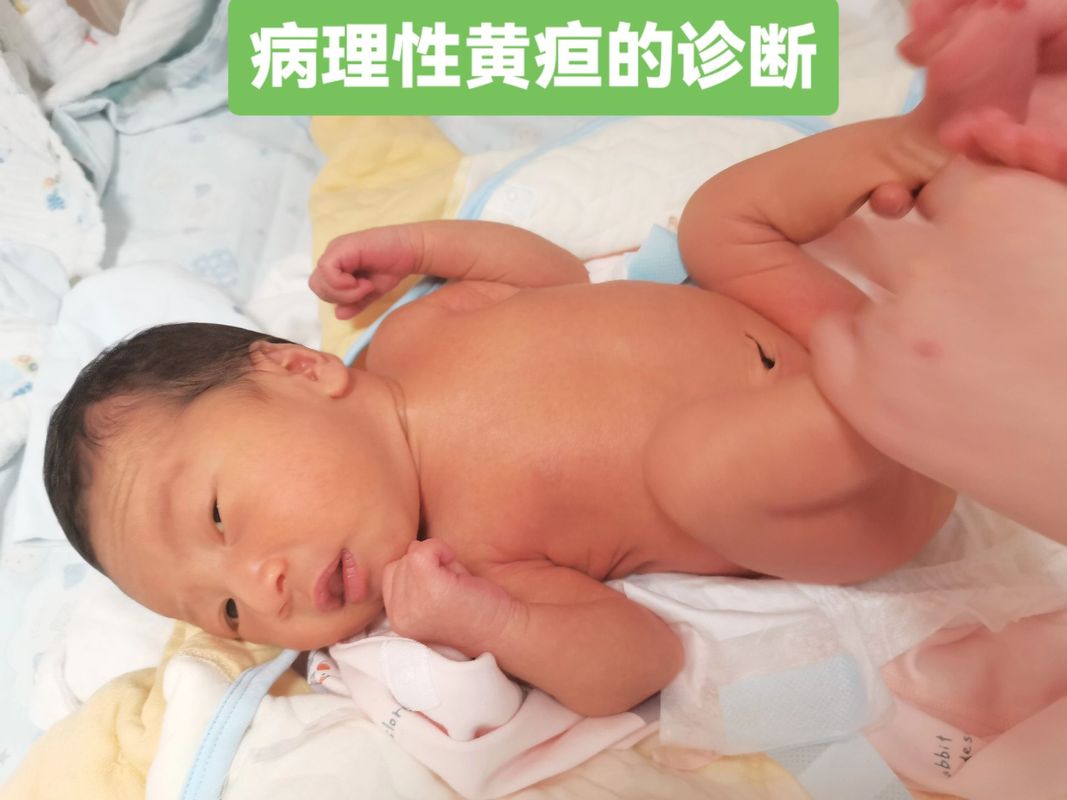 为何金黄葡萄球菌总成新生儿感染的隐形杀手？-第1张图片-郑州医学网