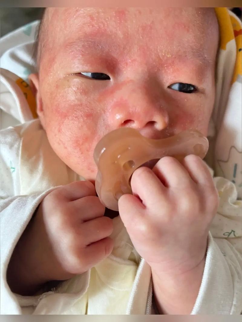 为何金黄葡萄球菌总成新生儿感染的隐形杀手？-第2张图片-郑州医学网