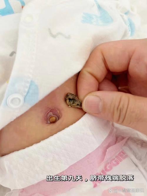 新生儿脐带脱落后洗澡,到底能不能碰水?该怎么护理才不会感染?-第1张图片-郑州医学网 新生儿脐带脱落后洗澡,到底能不能碰水?该怎么护理才不会感染?-第1张图片-郑州医学网