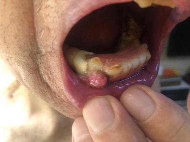 怀孕期间牙龈长肉瘤是孕期牙龈炎还是恶性病变？-第1张图片-郑州医学网