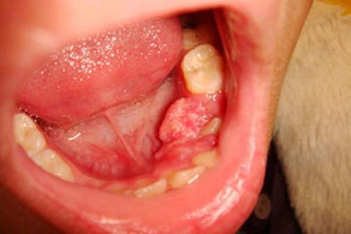 怀孕期间牙龈长肉瘤是孕期牙龈炎还是恶性病变？-第2张图片-郑州医学网