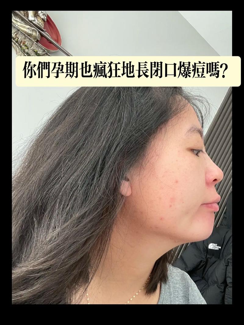 孕期长痘痘是激素变化导致的吗？如何安全应对孕期皮肤问题？-第2张图片-郑州医学网