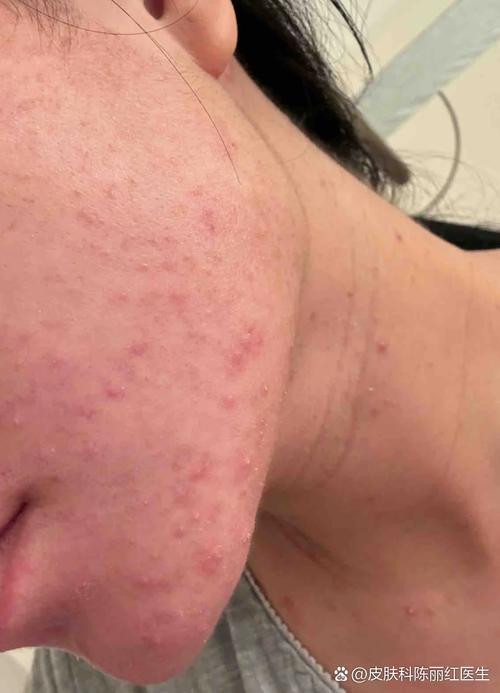 孕期长痘痘是激素变化导致的吗？如何安全应对孕期皮肤问题？-第3张图片-郑州医学网