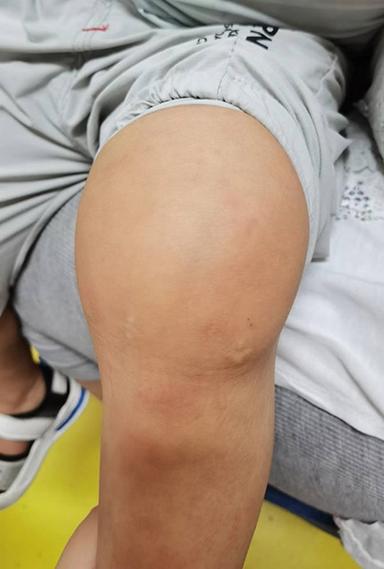 儿童髋关节滑膜炎有哪些典型症状？家长该如何早期识别与应对？-第1张图片-郑州医学网