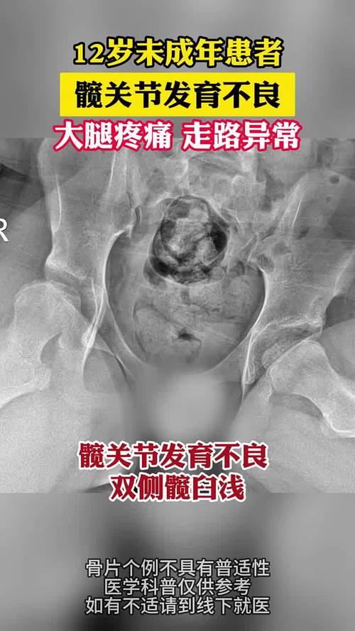 儿童髋关节滑膜炎有哪些典型症状？家长该如何早期识别与应对？-第3张图片-郑州医学网