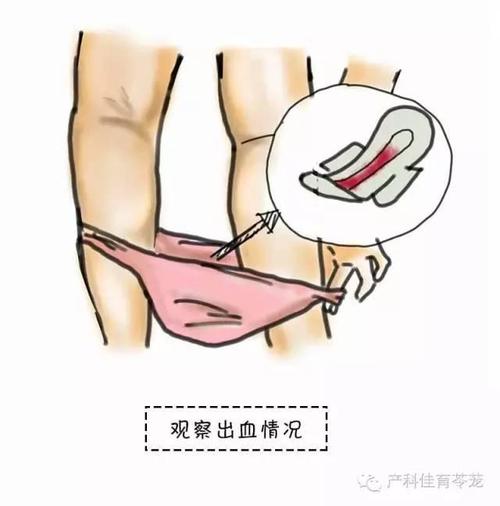 孕期分泌物检查后出血，是正常反应还是异常信号？需要立即就医吗？-第2张图片-郑州医学网