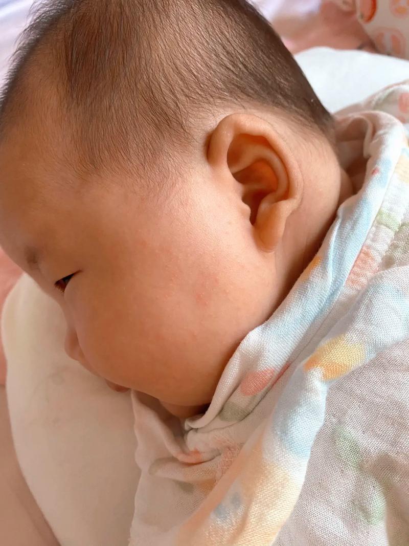 儿童脸湿疹反复发作,家长该如何科学护理与有效治疗?-第3张图片-郑州医学网 儿童脸湿疹反复发作,家长该如何科学护理与有效治疗?-第3张图片-郑州医学网