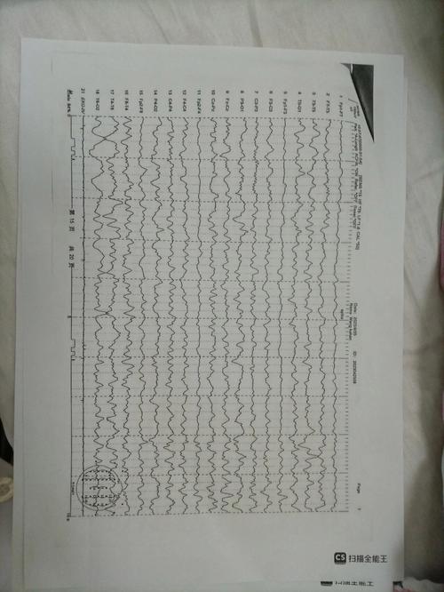 儿童脑电图能检查出哪些大脑异常问题？-第2张图片-郑州医学网